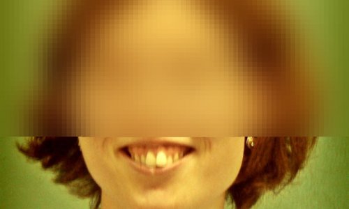 Uśmiech Dziąsłowy Przed