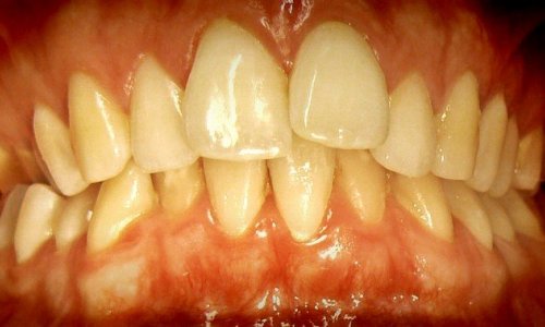 Napięcie Warg Przed