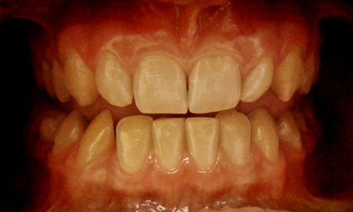 Szpary między zębami