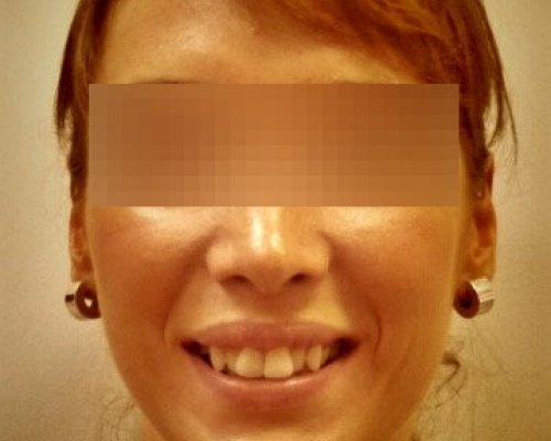 Wąski Uśmiech Przed