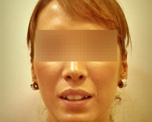 Nierówne Zęby Przed